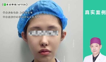 妈生灵动耳术后1个月对比