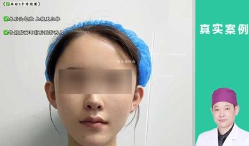 妈生灵动耳术后3个月对比